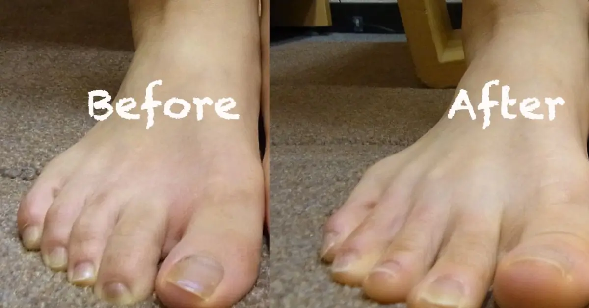 Hammer Toes Pictures Before and After